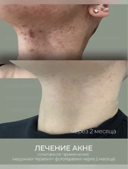 Как лечить акне эффективно?